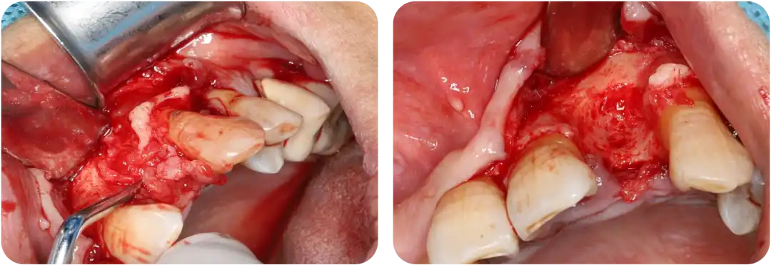 Immediate Implant Placement for Upper Anterior Teeth: DMDriving 3.5 Implants + GBR for Bone Grafting - 微信图片 20250123150707