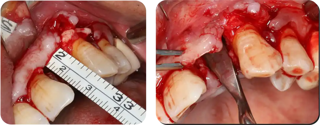 Immediate Implant Placement for Upper Anterior Teeth: DMDriving 3.5 Implants + GBR for Bone Grafting - 微信图片 20250123150715