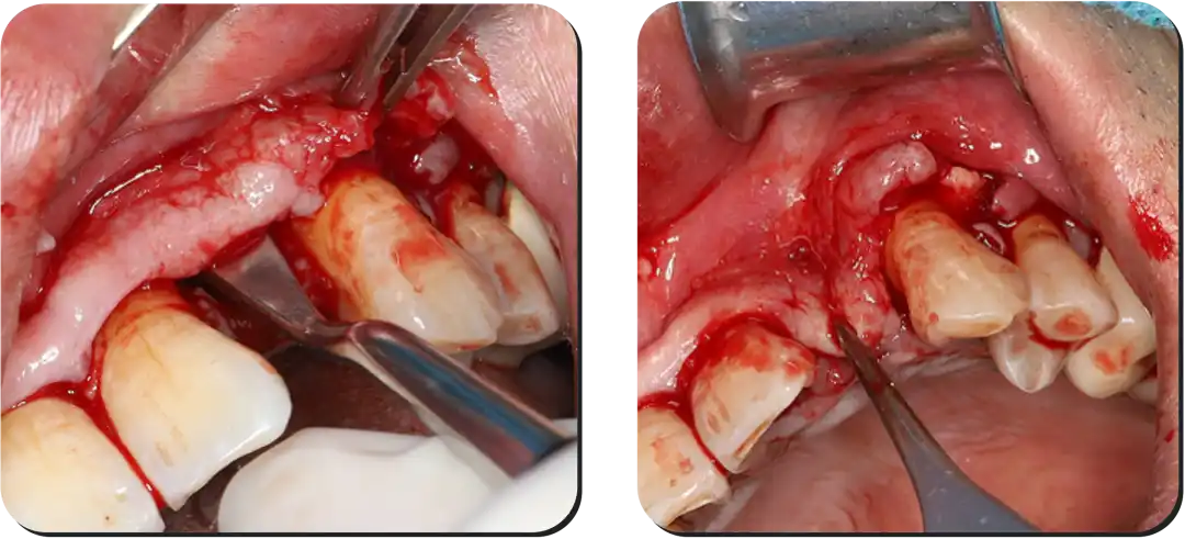 Immediate Implant Placement for Upper Anterior Teeth: DMDriving 3.5 Implants + GBR for Bone Grafting - 微信图片 20250123150719