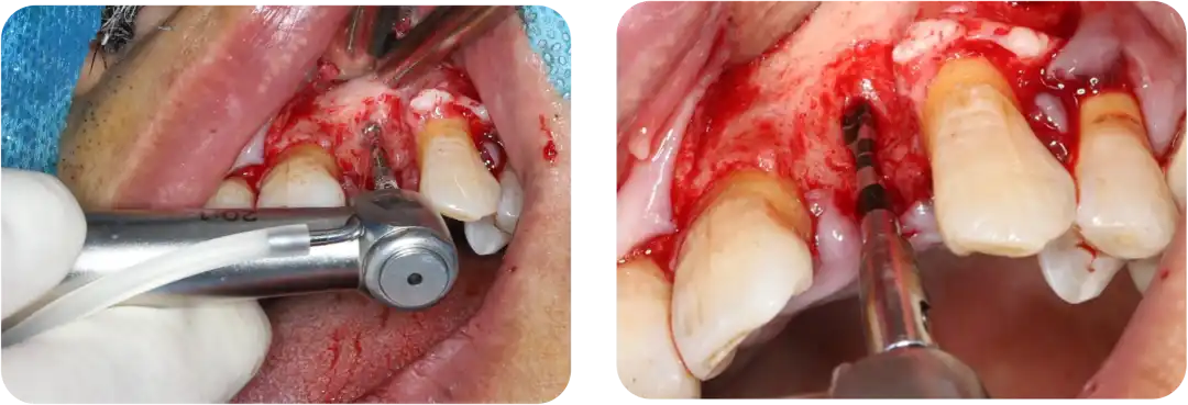 Immediate Implant Placement for Upper Anterior Teeth: DMDriving 3.5 Implants + GBR for Bone Grafting - 微信图片 20250123150730