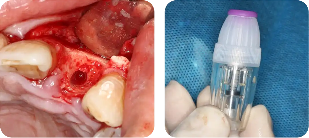 Immediate Implant Placement for Upper Anterior Teeth: DMDriving 3.5 Implants + GBR for Bone Grafting - 微信图片 20250123150735