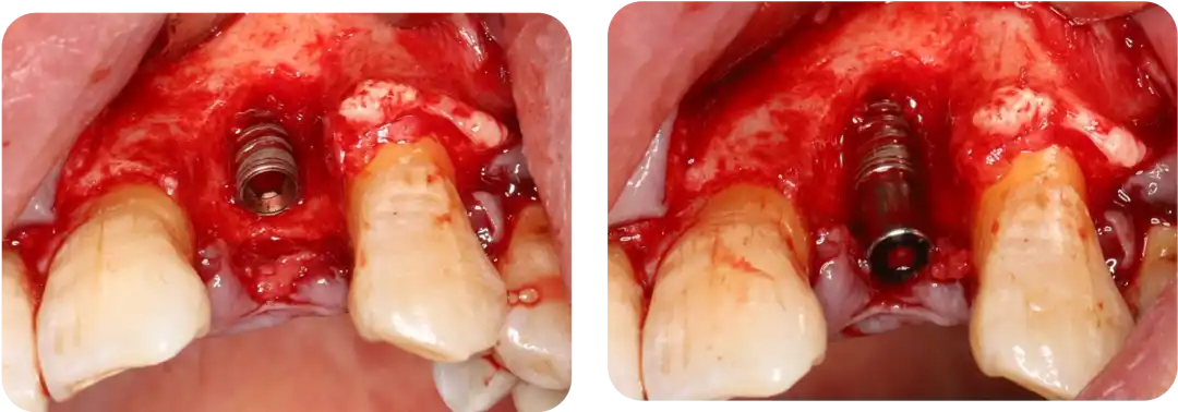 Immediate Implant Placement for Upper Anterior Teeth: DMDriving 3.5 Implants + GBR for Bone Grafting - 微信图片 20250123150743