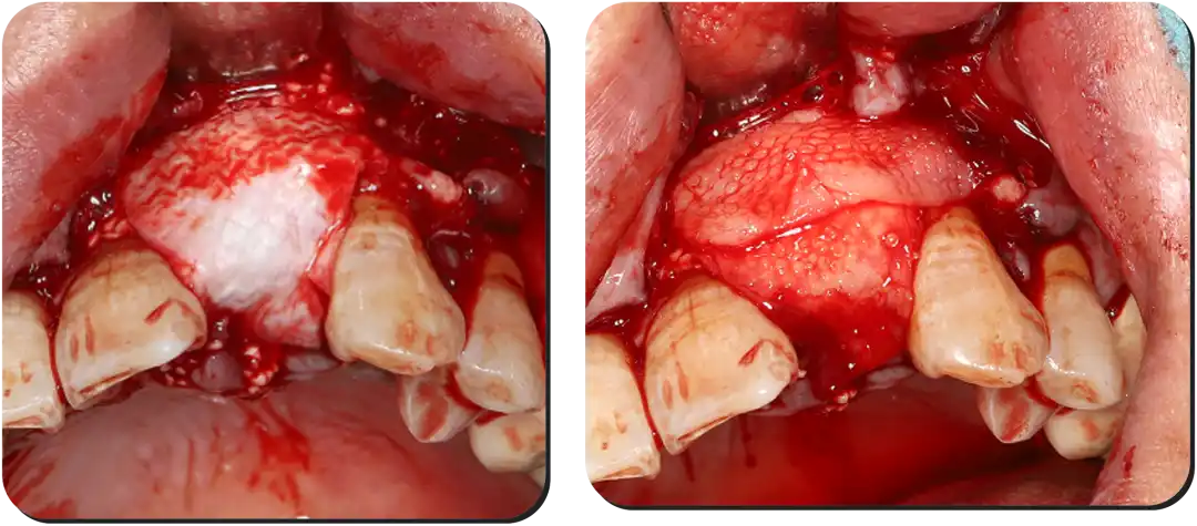 Immediate Implant Placement for Upper Anterior Teeth: DMDriving 3.5 Implants + GBR for Bone Grafting - 微信图片 20250123150757 1