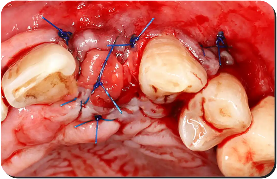 Immediate Implant Placement for Upper Anterior Teeth: DMDriving 3.5 Implants + GBR for Bone Grafting - 微信图片 20250123150801 1