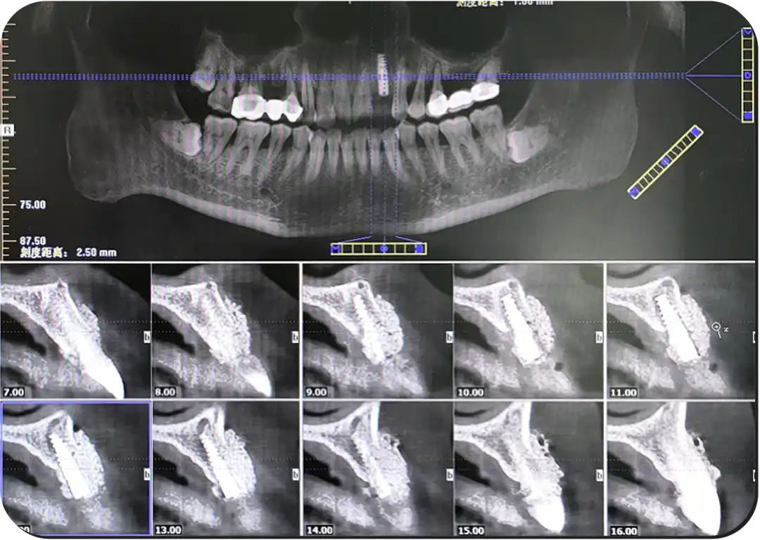 Immediate Implant Placement for Upper Anterior Teeth: DMDriving 3.5 Implants + GBR for Bone Grafting - 微信图片 20250123150805