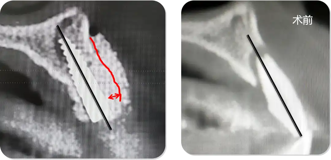 Immediate Implant Placement for Upper Anterior Teeth: DMDriving 3.5 Implants + GBR for Bone Grafting - 微信图片 20250123150810 1