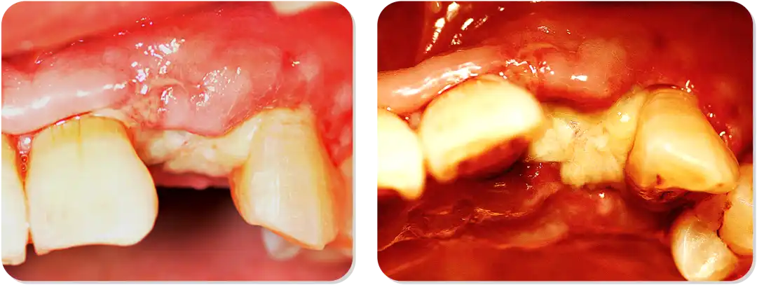 Immediate Implant Placement for Upper Anterior Teeth: DMDriving 3.5 Implants + GBR for Bone Grafting - 微信图片 20250123150831