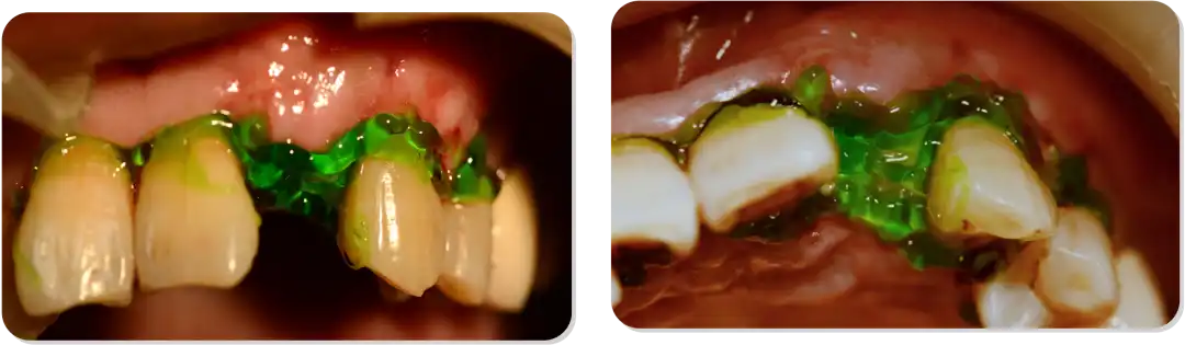 Immediate Implant Placement for Upper Anterior Teeth: DMDriving 3.5 Implants + GBR for Bone Grafting - 微信图片 20250123150835