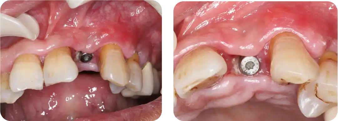 Immediate Implant Placement for Upper Anterior Teeth: DMDriving 3.5 Implants + GBR for Bone Grafting - 微信图片 20250123162717