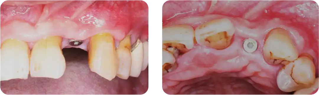 Immediate Implant Placement for Upper Anterior Teeth: DMDriving 3.5 Implants + GBR for Bone Grafting - 微信图片 20250123162722