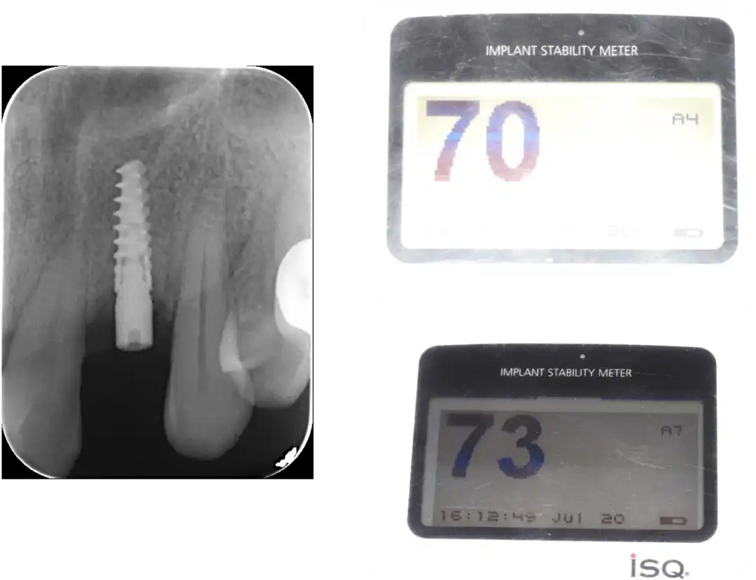 Immediate Implant Placement for Upper Anterior Teeth: DMDriving 3.5 Implants + GBR for Bone Grafting - 微信图片 20250123162726