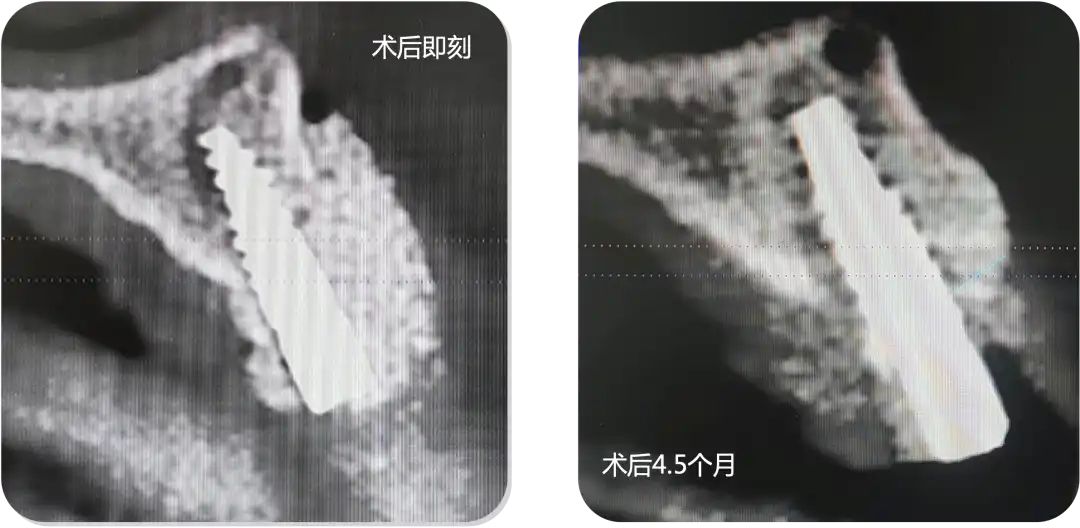 Immediate Implant Placement for Upper Anterior Teeth: DMDriving 3.5 Implants + GBR for Bone Grafting - 微信图片 20250123162731