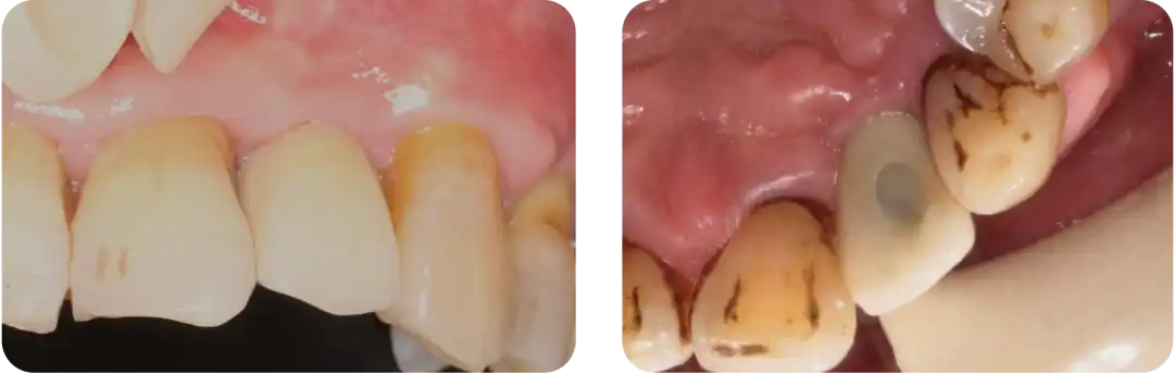 Immediate Implant Placement for Upper Anterior Teeth: DMDriving 3.5 Implants + GBR for Bone Grafting - 微信图片 20250123162735