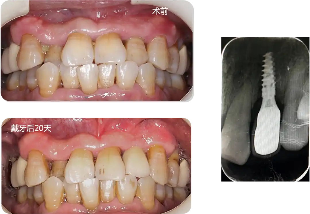 Immediate Implant Placement for Upper Anterior Teeth: DMDriving 3.5 Implants + GBR for Bone Grafting - 微信图片 20250123162739 2