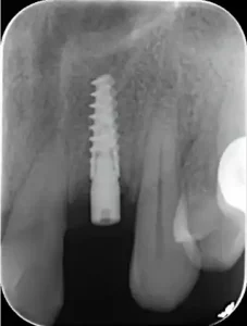 Dental implants Case -2