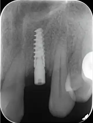 Implants dentaires Cas -2