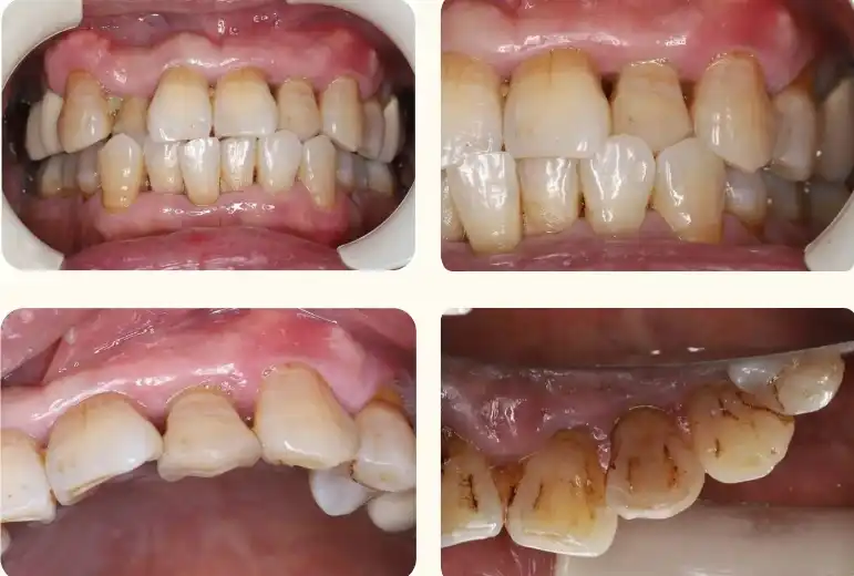 Preoperative intraoral condition of the patient