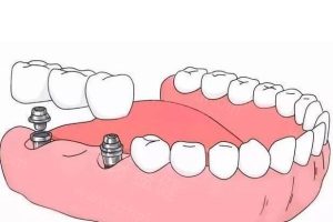 Custom Abutment Implant Code