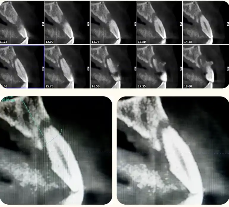 The CBCT coronal view of tooth 22 shows a buccal-lingual alveolar ridge width of 6.41mm, with 1/2 vertical bone loss and no vertical soft tissue loss.