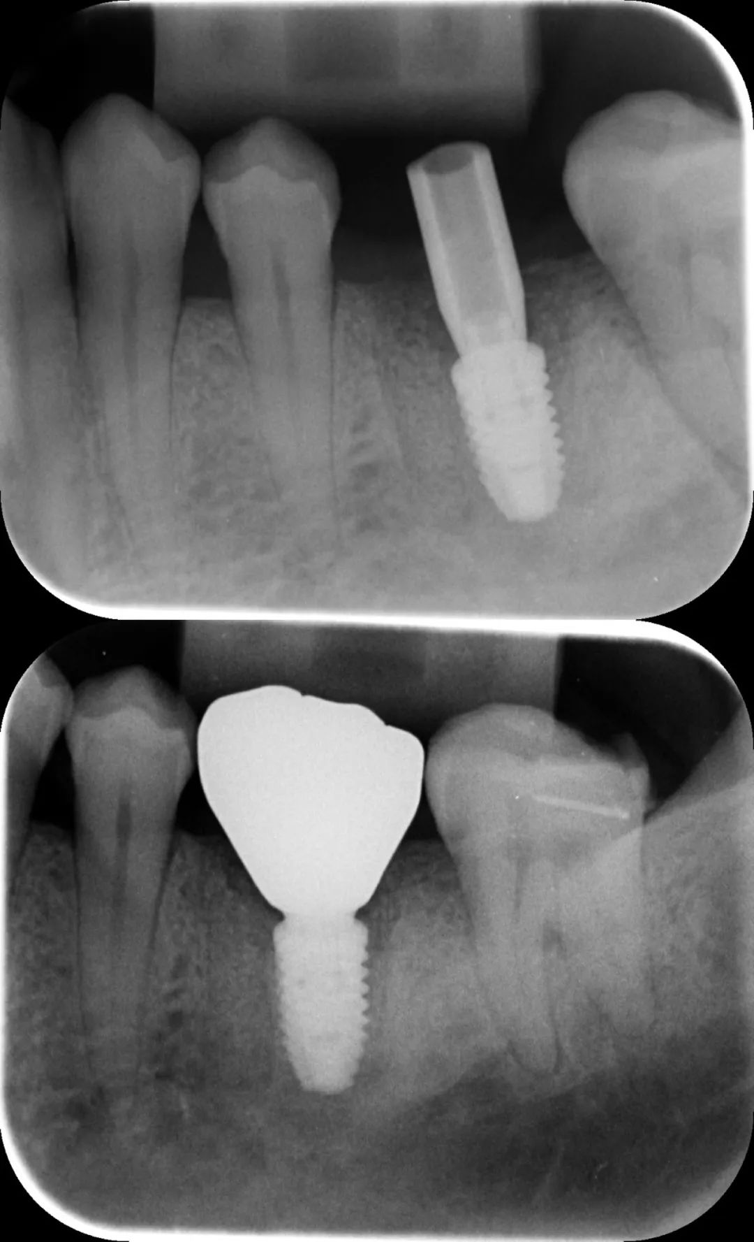 Post-restoration X-ray