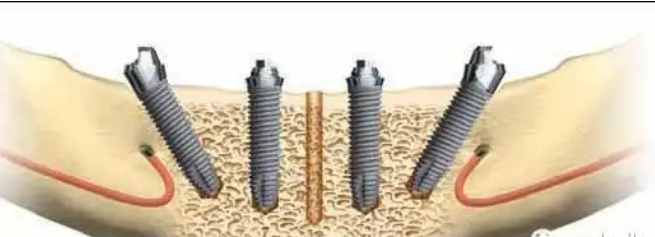 All-on-4 implant procedure