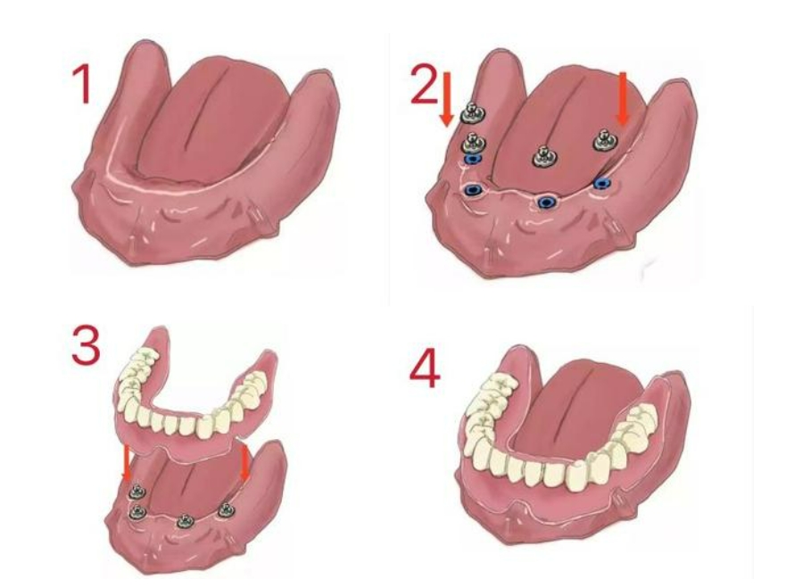 Procedure: How Does It Work?