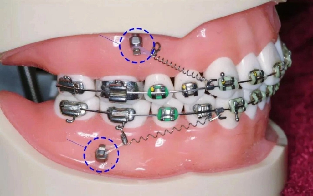 Understanding Orthodontic Anchorage: The Role of Mini-Screws and TADs in Modern Orthodontics