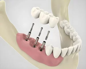 Immediate Tooth Implants