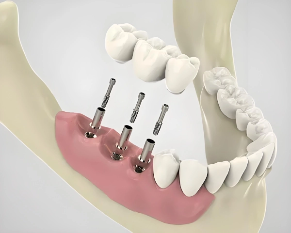 Leading Dental Implant Companies in the USA