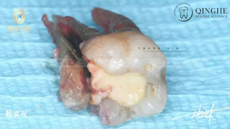 Minimally Invasive Extraction and Socket Preparation