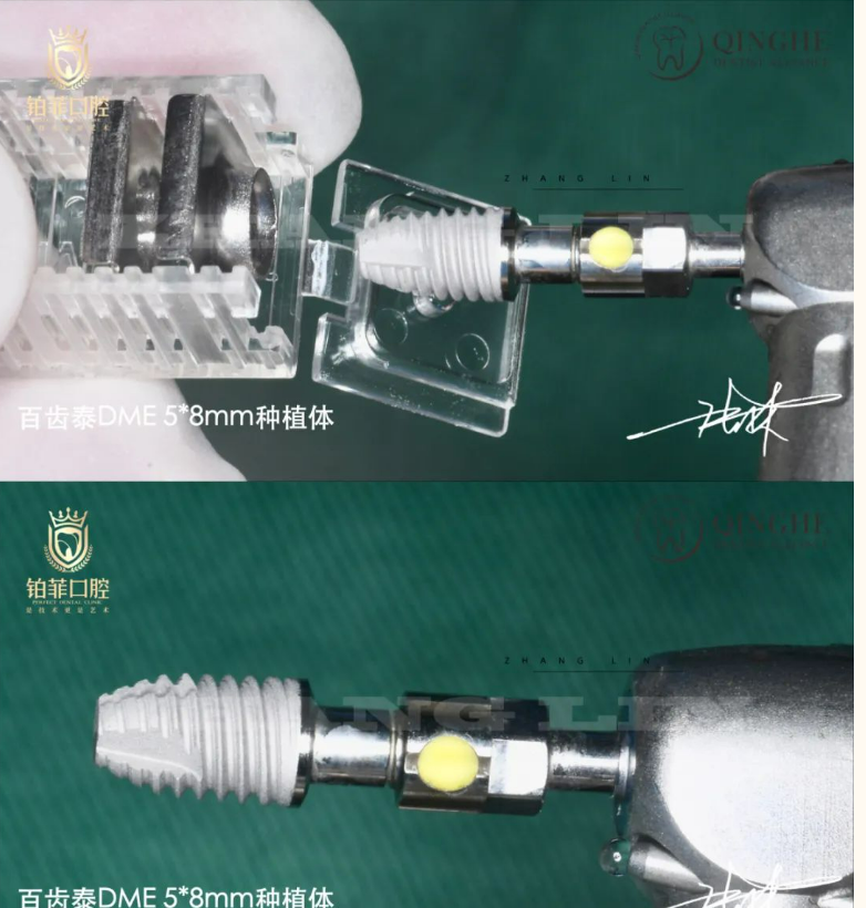 immediate implant of the DentalMaster DMEqual 5.0*8 model