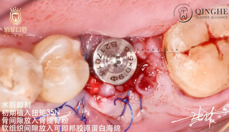 Bone Graft and Healing Abutment Placement