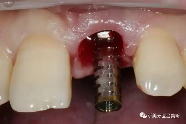 Temporary Abutments for Dental Implants: Everything You Need to Know