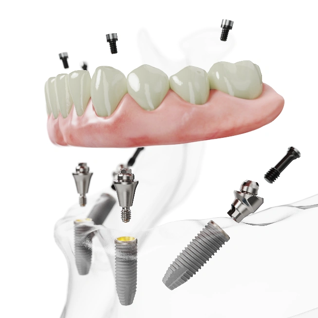 Nobel Biocare Implant Size Chart