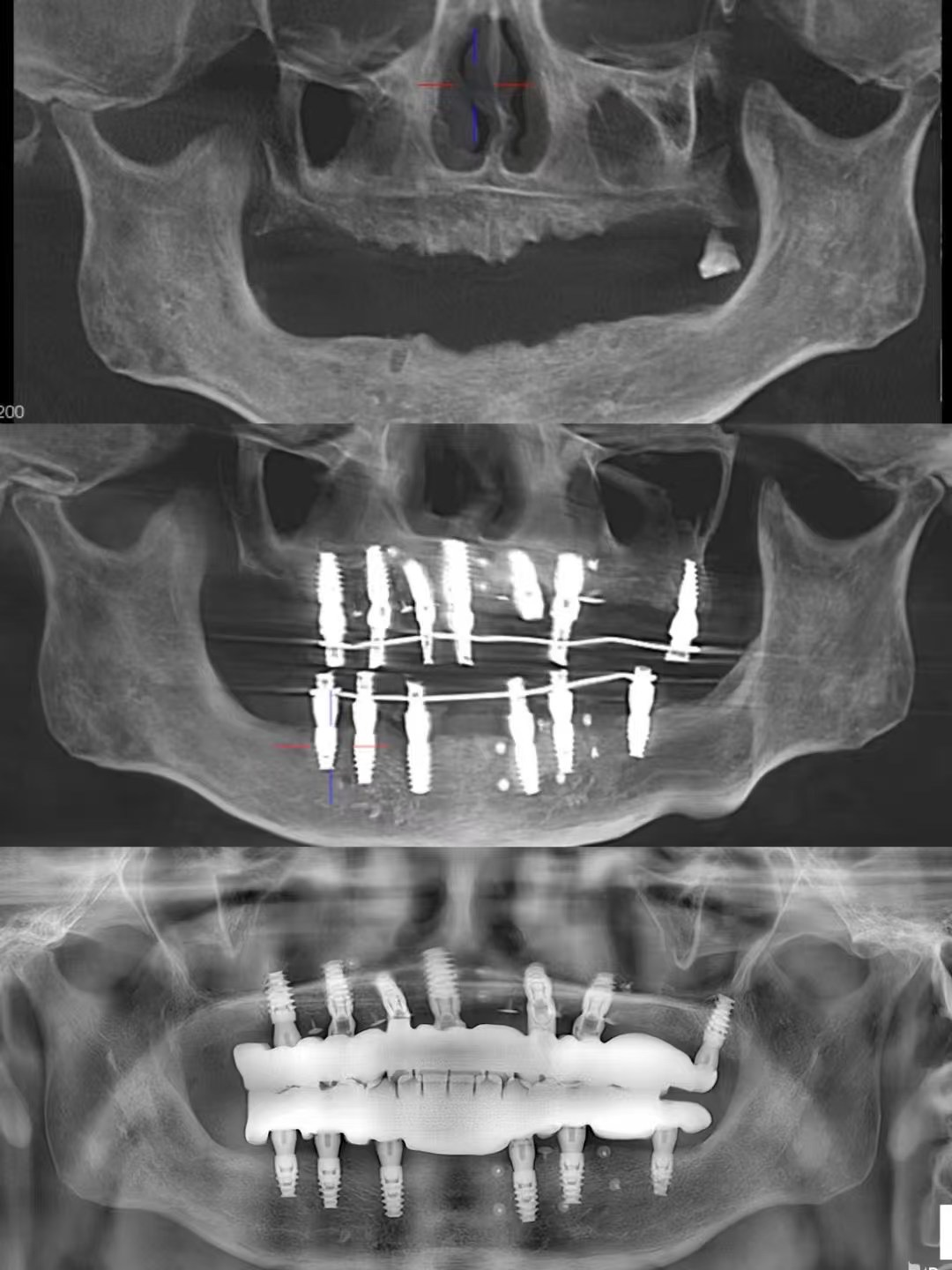 DentalMaster Edentulous Case Study - Estudo de caso Edentulous 1