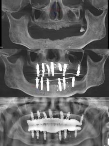 Edentulous Case Study