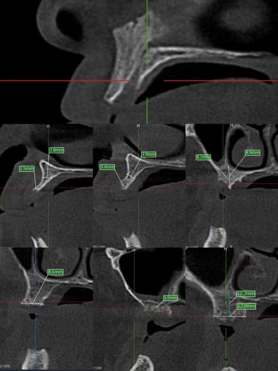 Estudo de caso DentalMaster Edentulous - Estudo de caso Edentulous1