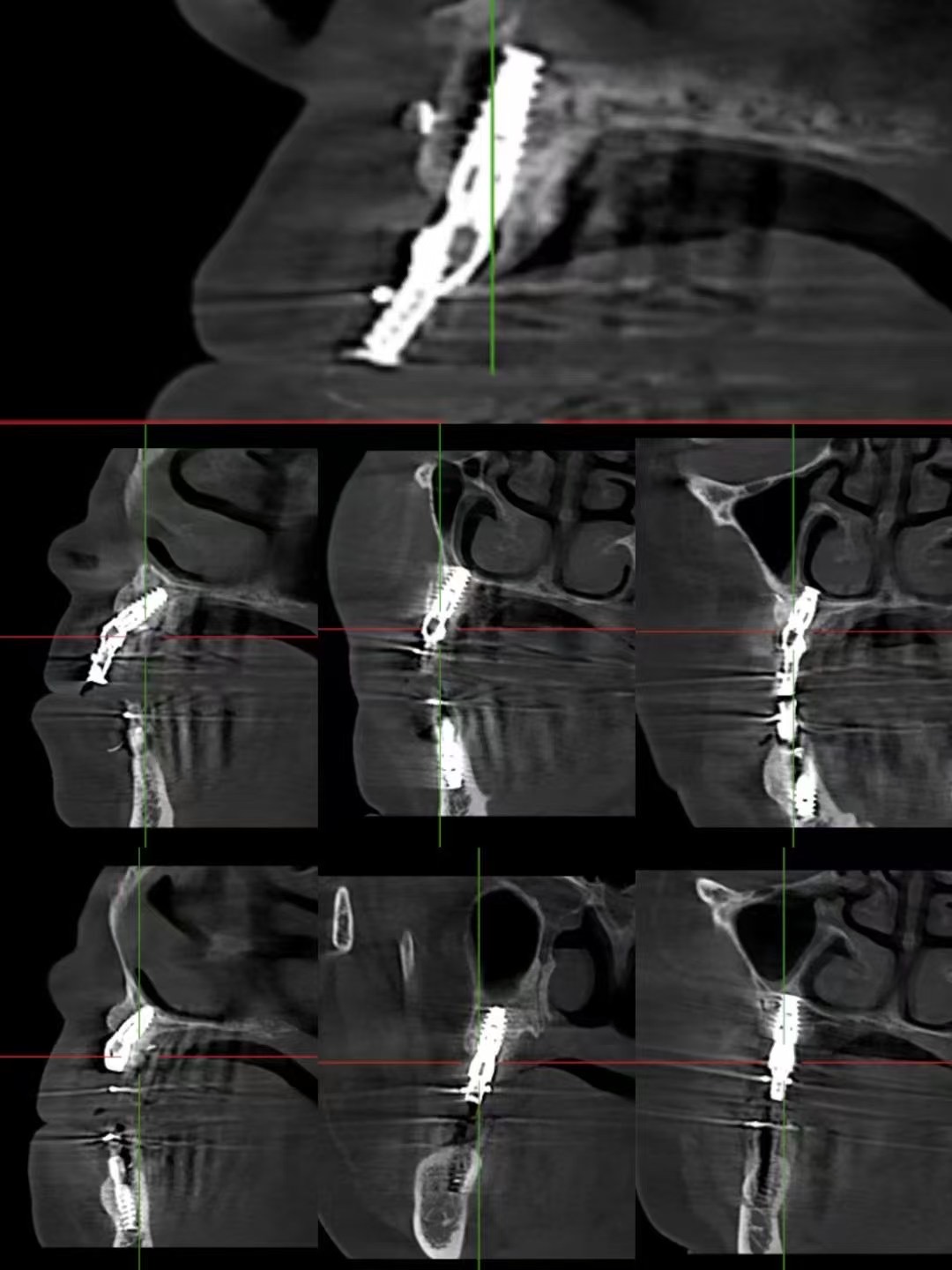 Estudo de caso DentalMaster Edentulous - Estudo de caso Edentulous2