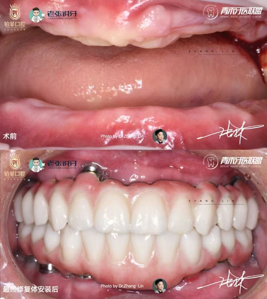 Estudo de caso DentalMaster Edentulous - Estudo de caso Edentulous3