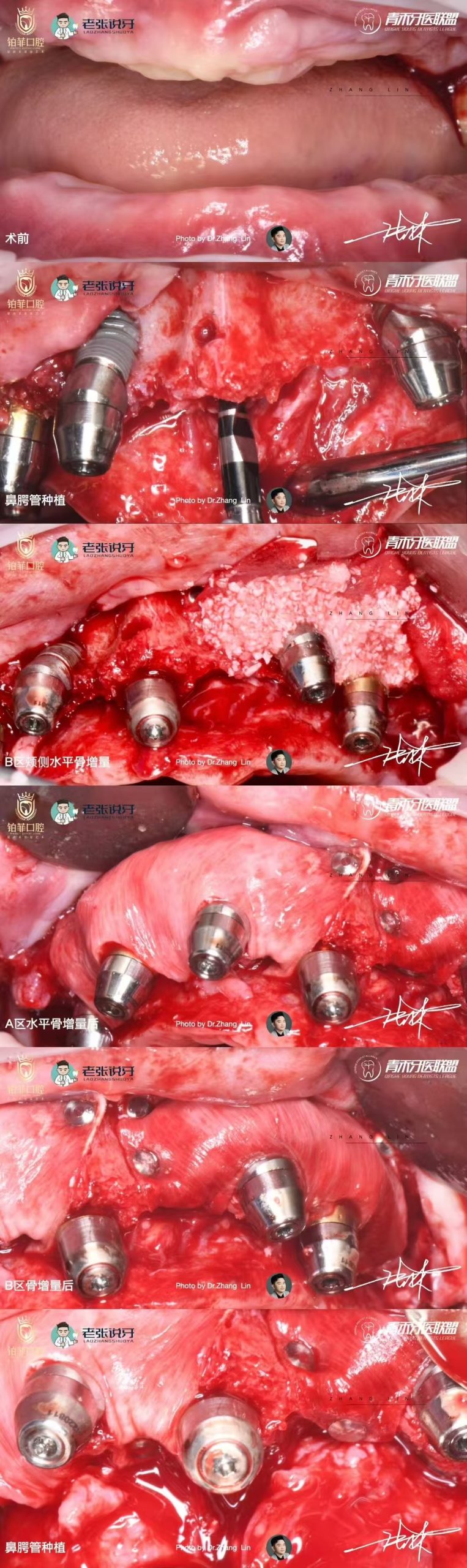 DentalMaster Edentulous Case Study - Estudo de caso Edentulous4 à escala