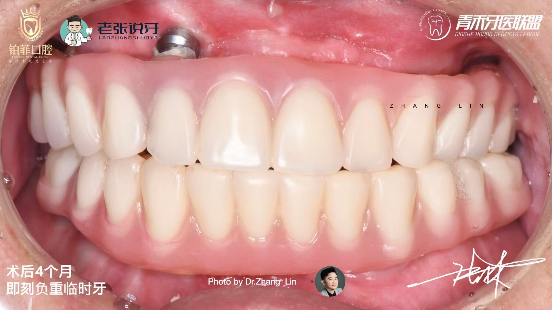 DentalMaster Edentulous Case Study - Edentulous Case Study5