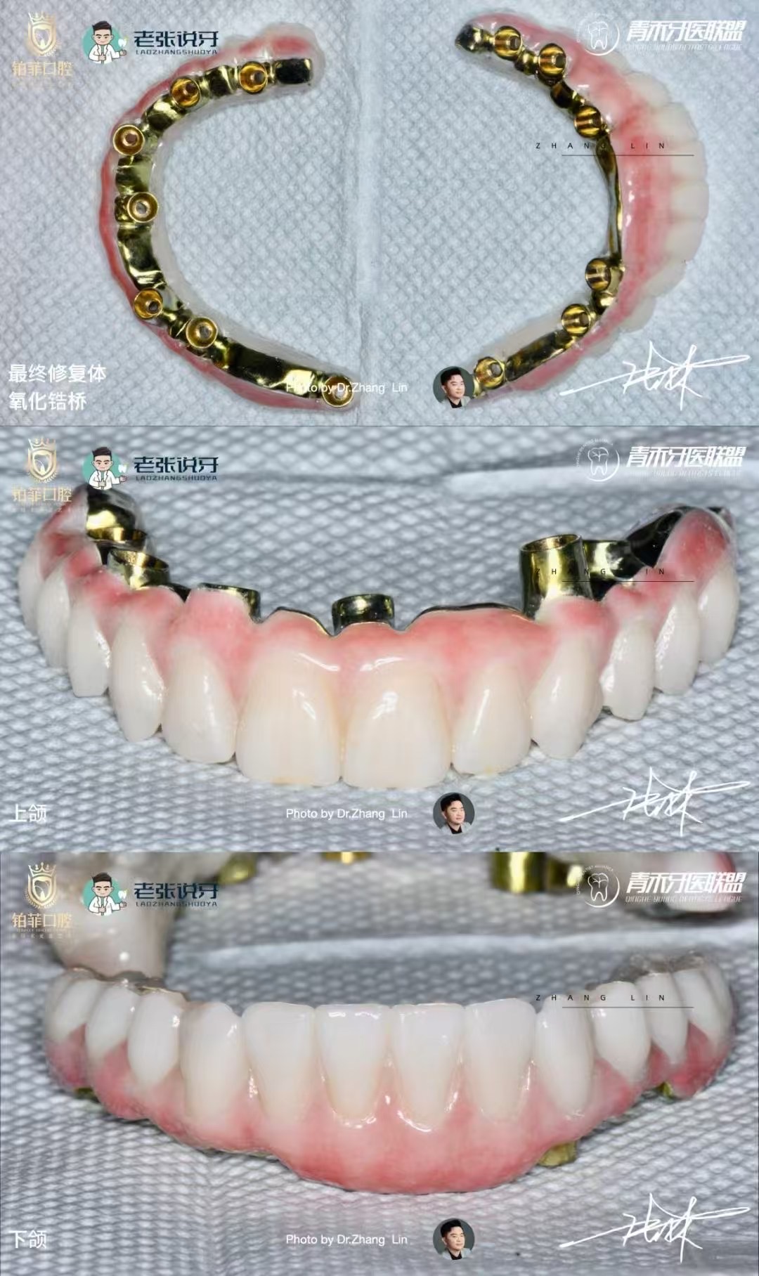 DentalMaster Edentulous Case Study - Edentulous Case Study6 1