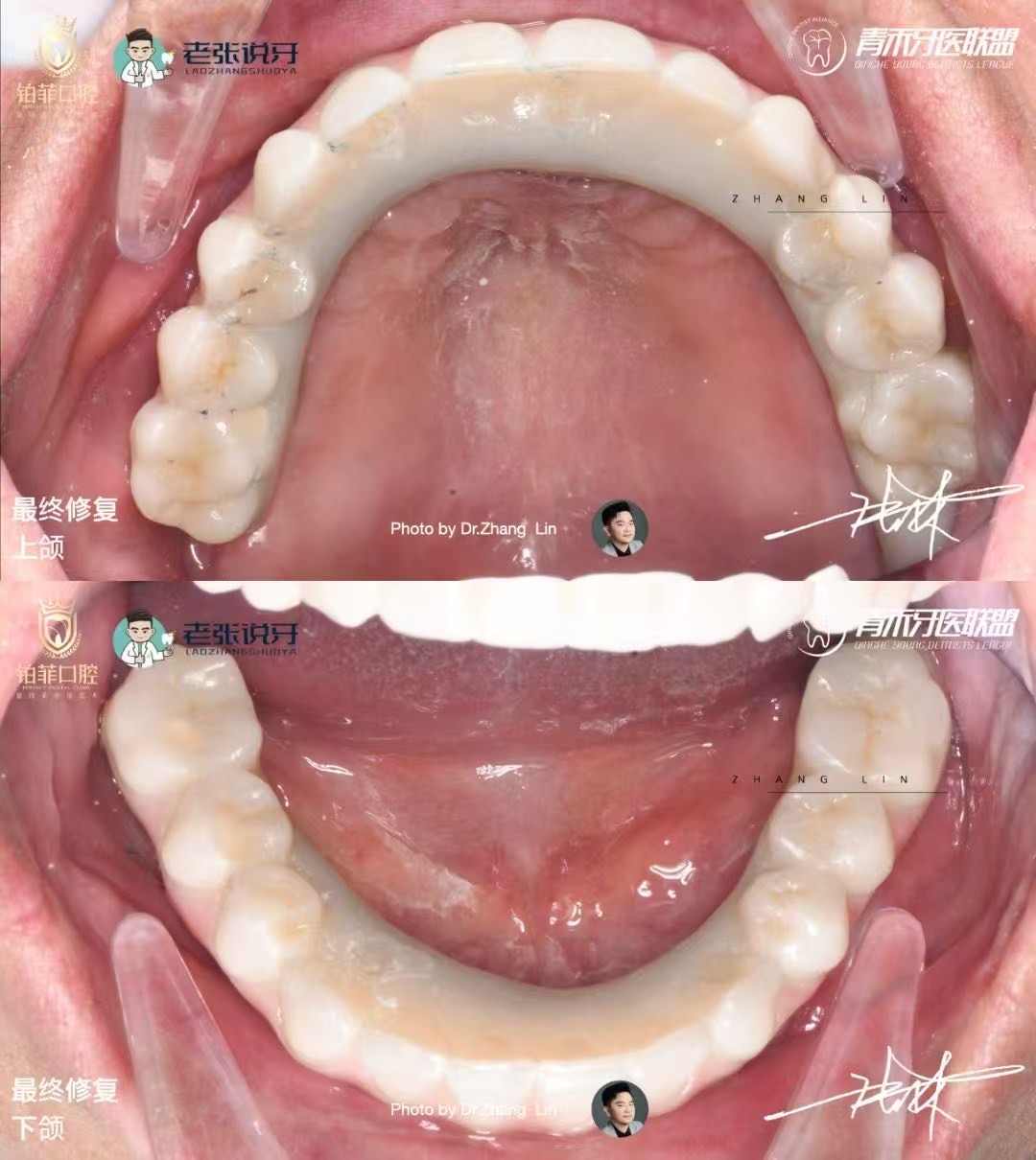 DentalMaster Edentulous Case Study - Edentulous Case Study8