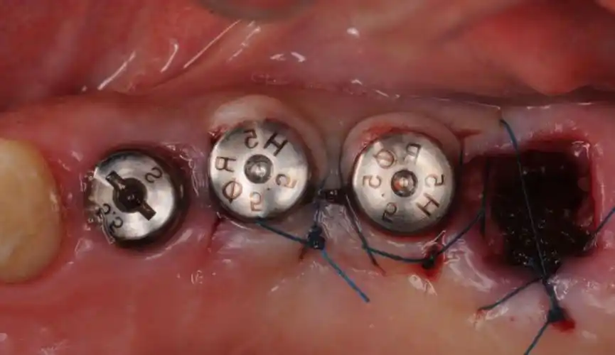 What is a healing abutment for a dental implant 1 インプラント用ヒーリング・アバットメント